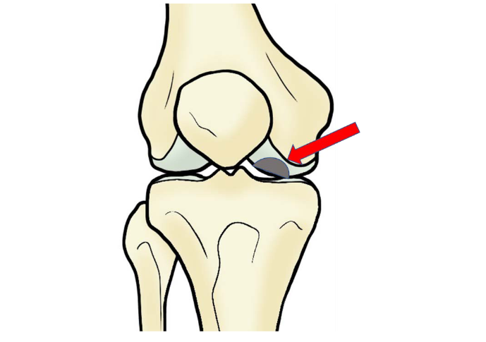 図4 膝離断性骨軟骨炎の病態