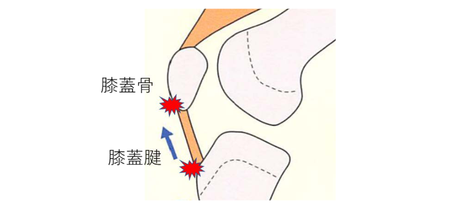 図5 ジャンパー膝の病態