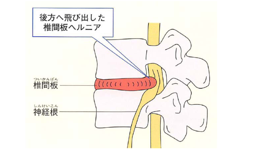 図9 腰椎椎間板ヘルニアの病態