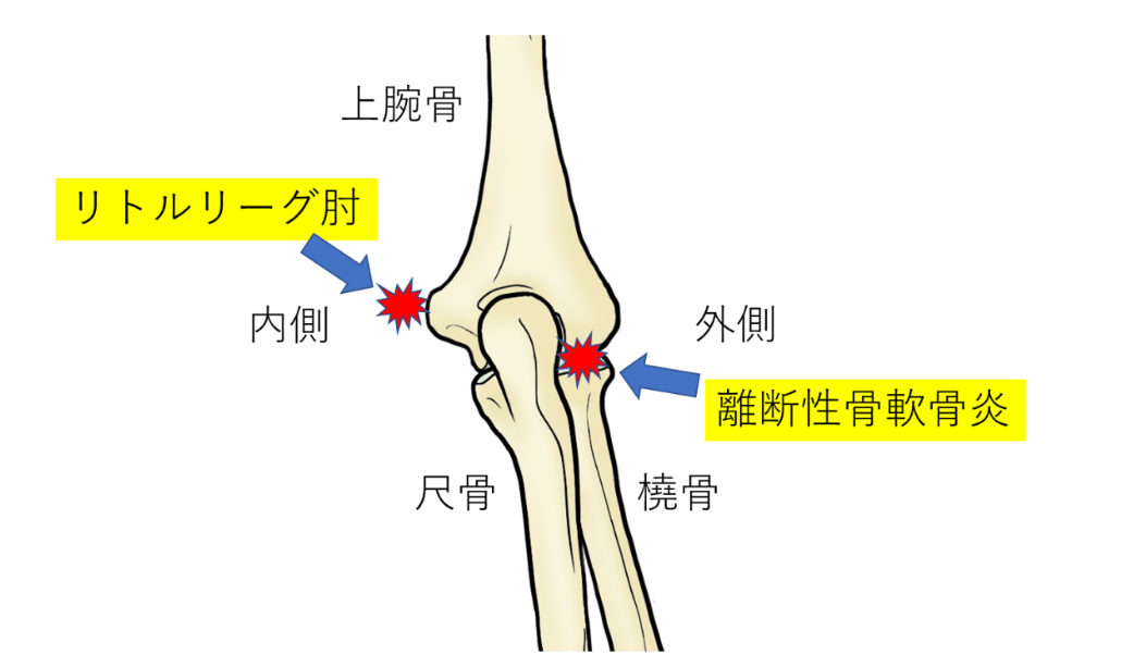 図8 野球肘で障害の生じる部位