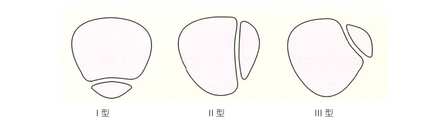 図3 有痛性二分膝蓋骨の種類