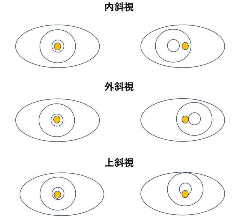 角膜反射による斜視の検出