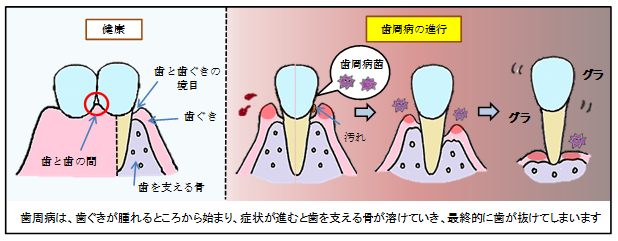 歯周病